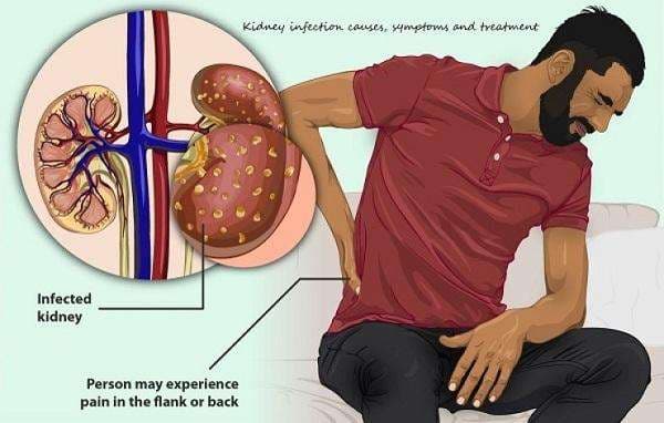 Kidney Infection Treatment: Effective Medicine & Remedies in Accra, Ghana