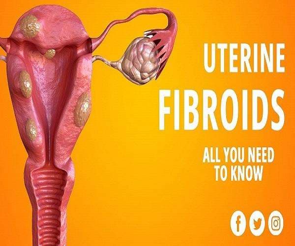 Fibroids Treatment: Effective Medicine & Natural Remedies Without Surgery in Accra, Ghana