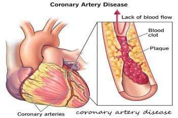 Coronary Artery Disease Treatment: Effective Medicine & Remedies in Accra, Ghana