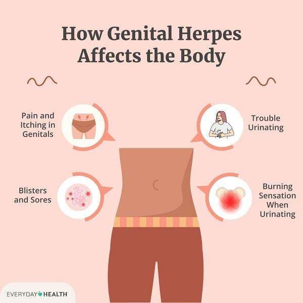 Genital Herpes Treatment: Effective Medicine & Remedies in Accra, Ghana