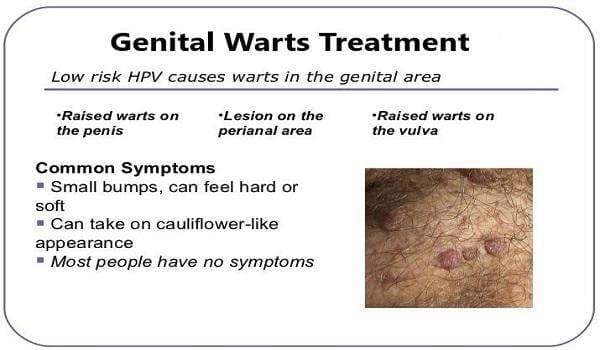 Genital Warts Treatment: Effective Medicine & Removal Cream in Accra, Ghana