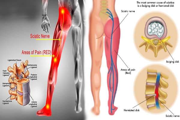 Sciatica Treatment: Effective Medicine & Remedies in Accra, Ghana