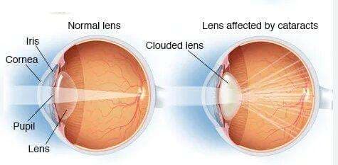 Glaucoma & Cataract Treatment: Effective Supplements in Accra, Ghana